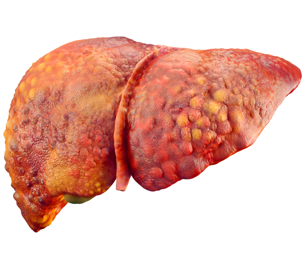 Fatty Liver Disease Treatment Overview