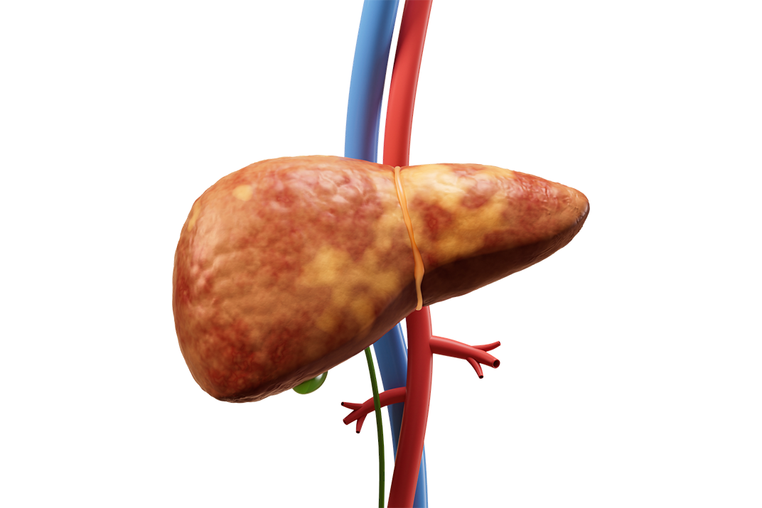 What is Fatty Liver Disease