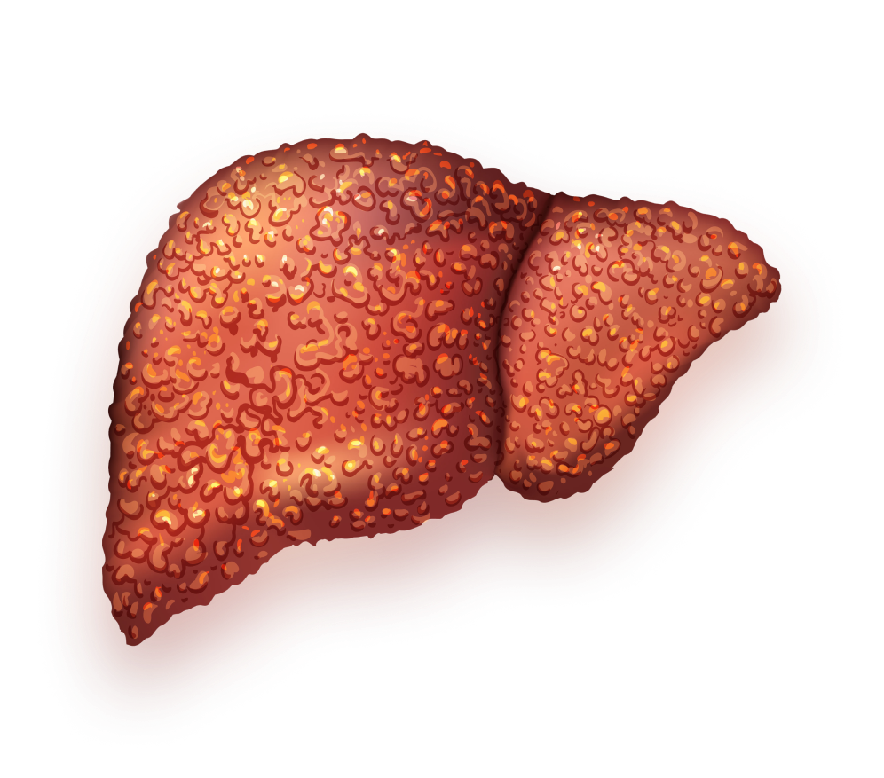 Liver Cancer Treatment Overview