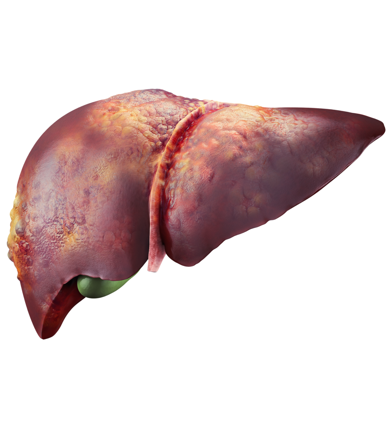 What is Liver Cancer