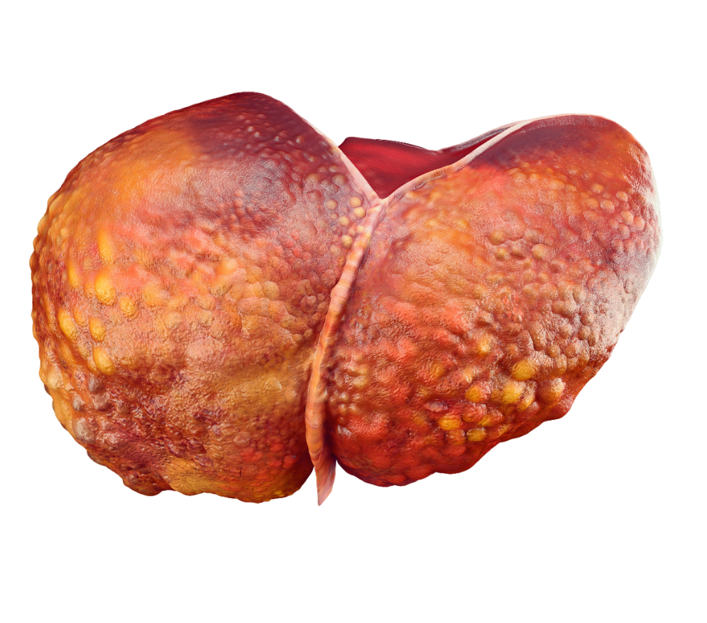 Liver Cirrhosis Treatment Overview