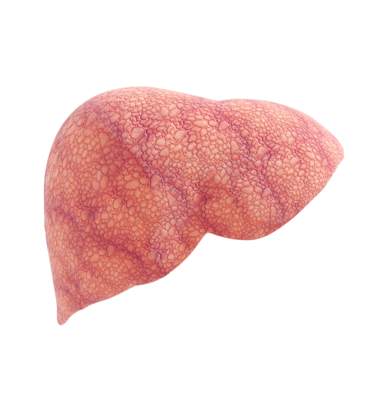 What is Liver Cirrhosis