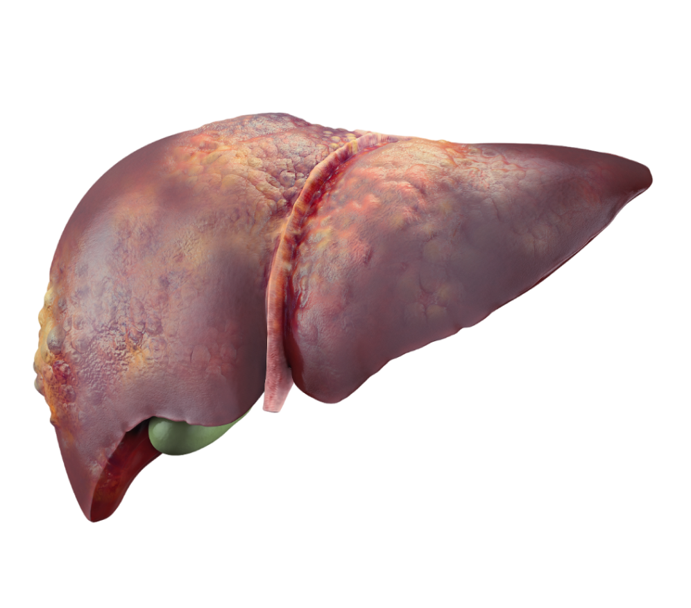 Non-Alcoholic Fatty Liver Disease Treatment Overview